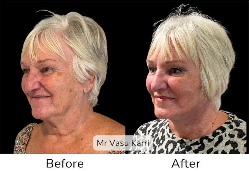 Facelift Patient 4 View 3